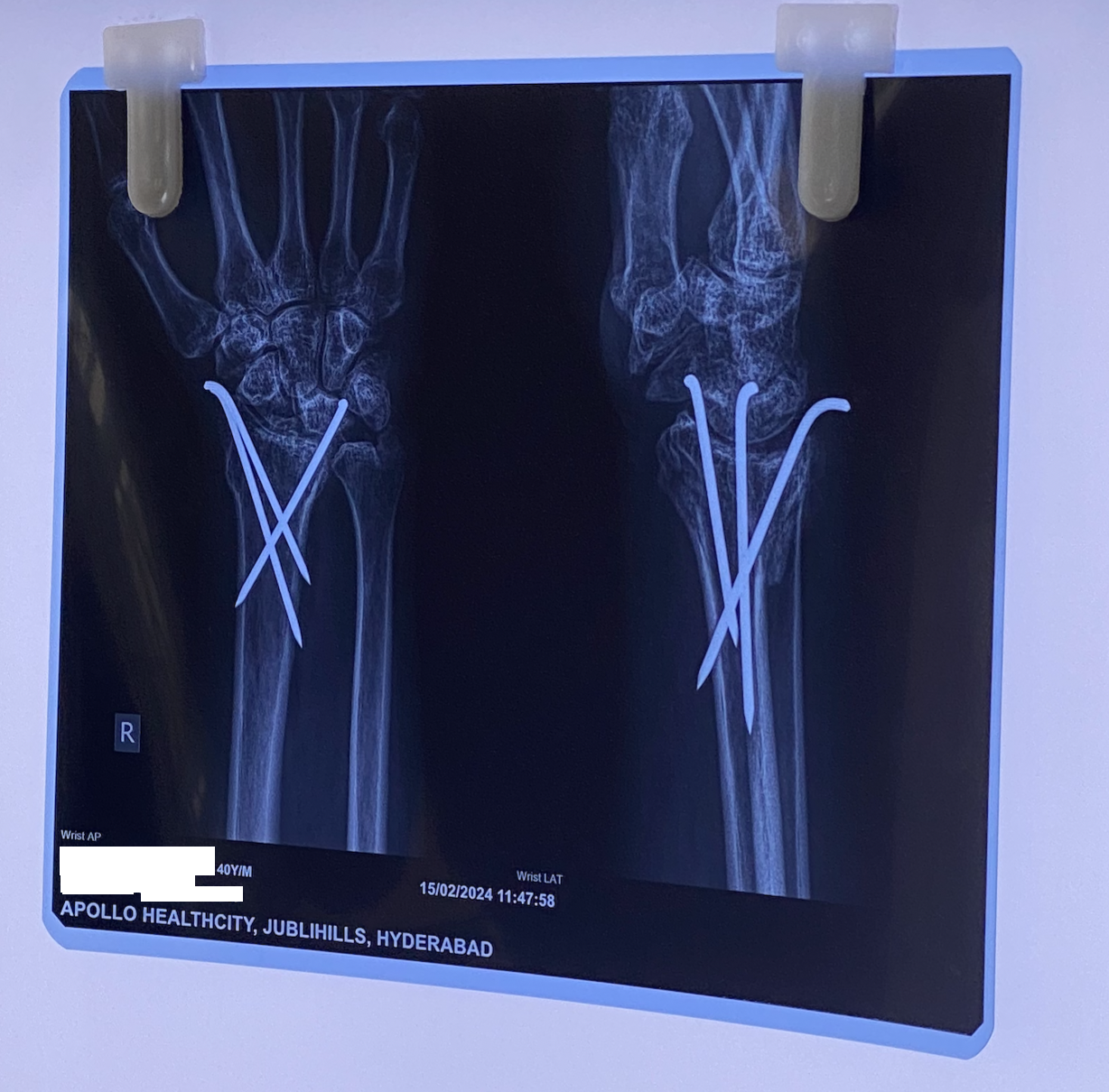 Wrist X-ray (AP and lateral views) showing K-wire fixation after orthopaedic surgery, Apollo HealthCity, Hyderabad